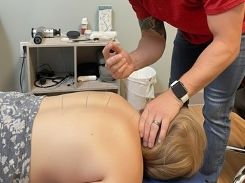 Acupuncture