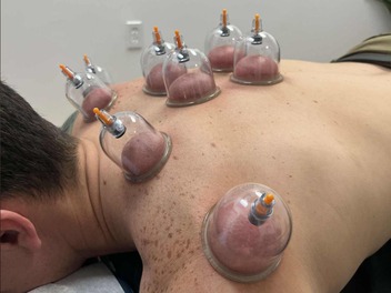 Myofascial Cupping Jacksonville FL